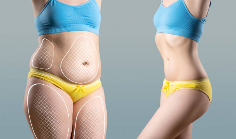 Clinica de Aplicação de Enzimas na Barriga Araraquara - Aplicação de Enzimas na Papada Clinica de Aplicação de Enzimas na Barriga Araraquara - Aplicação de Enzimas na Papada