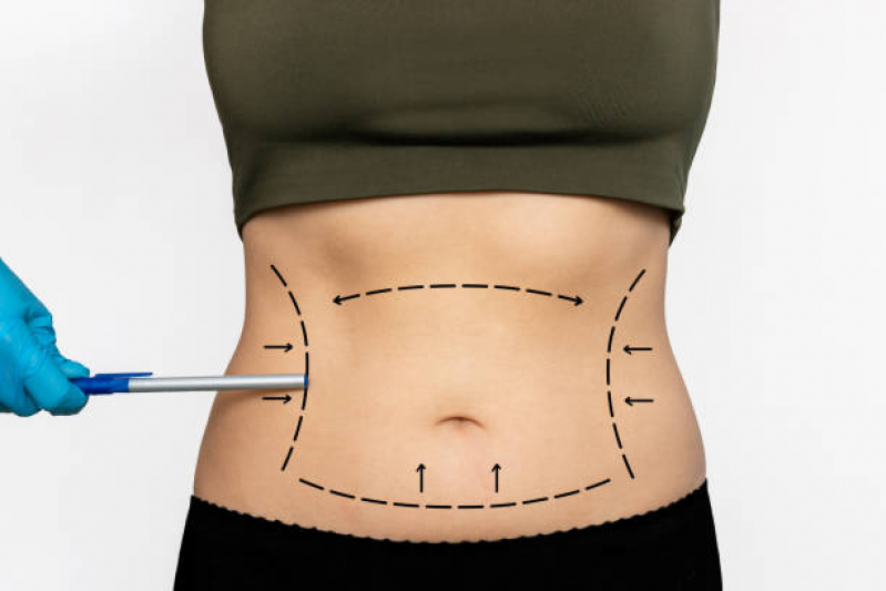 Lipo Enzimática para Gordura Localizada Marcar Chácara Flora - Aplicação de Enzimas na Papada Lipo Enzimática para Gordura Localizada Marcar Chácara Flora - Aplicação de Enzimas na Papada
