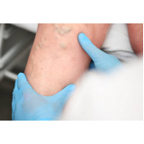 clinica de procedimento para secar varizes ABC