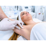 aplicação de botox nas axilas Vila Joaniza