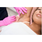 clinica de aplicação de botox nas axilas Vila Sônia