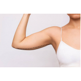 clinica de lipo enzimática nos braços Chácara Flora