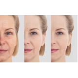 clinica que faz peeling químico no rosto Cupecê