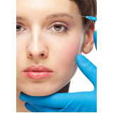 microagulhamento com peeling Chácara Klabin