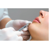 microagulhamento para estrias Cupecê