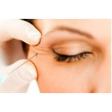 preenchimento facial valor Vila Cordeiro