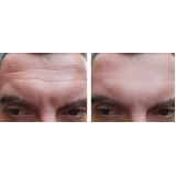 preenchimento maxilar masculino valor Jardim São Luís