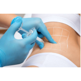 procedimento de enzima intramuscular para acelerar o metabolismo Cidade Ademar