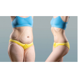 procedimento de enzimas para emagrecer intramuscular Vila Clementino