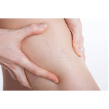 tratamento com ventosas para dores musculares marcar Moema